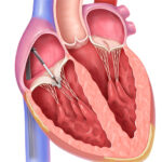 This illustration shows the catheter-delivered TriClip implantation in the tricuspid valve.