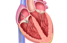 This illustration shows the catheter-delivered TriClip implantation in the tricuspid valve.