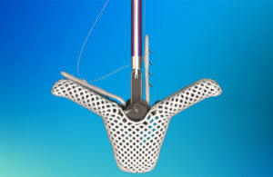 A photo of the Abbott TriClip clip heart valve implant.