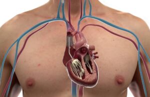CroiValve-Duo