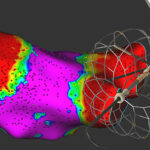 An image showing the Medtronic Affera Sphere-360 pulsed field ablation (PFA) catheter.