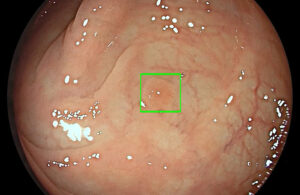 An image from the The Medtronic GI Genius ColonPro polyp detection system, which has identified a potential sign of cancer with a green box.
