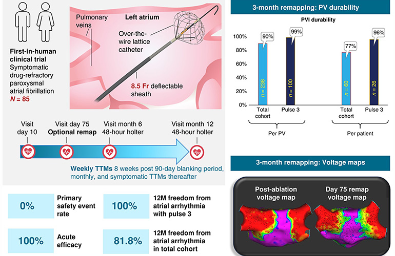 An image showing results from Dr. Vivek Reddy's first-in-human study of the Medtronic Sphere-360 pulsed field ablation catheter.