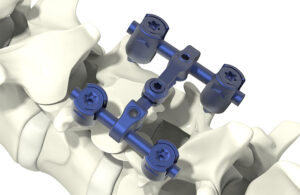 An image of SeaSpine Mariner pedicle screws coated with Orthobond's Ostaguard antimicrobial technology.