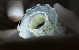 A photo of Capstan Medical's mitral valve implant, which uses nitinol.