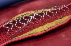 An illustration of the Elixir Dynamx drug-eluting coronary bioadaptor, which features a bioabsorbable polymer unlocking mechanism.