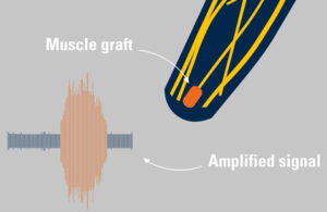 A illustration showing how the Blue Arbor Technologies Restore Neuromuscular Interface System amplifies nerve signals using electrodes implanted in muscle grafts.