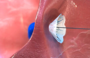 An illustration showing the Ventura implant anchoring to the patient's fossa ovalis.