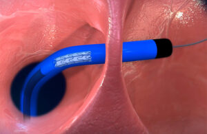An illustration showing the V-Wave Ventura interatrial shunt's nitinol frame collapsed down for catheter delivery.