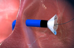 An illustration showing the V-Wave Ventura implant's nitinol frame self-expanding when it emerges from the introducer sheath.
