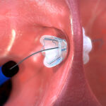 An illustration showing the V-Wave Ventura interatrial shunt being anchored inside a patient's heart before the guidewire is retracted.