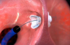 An illustration showing the V-Wave Ventura interatrial shunt being anchored inside a patient's heart before the guidewire is retracted.