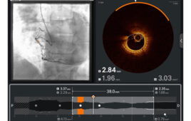A screenshot of Abbott's Ultreon intravascular imaging software.