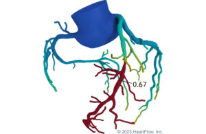 A graphic showing HeartFlow’s Fractional Flow Reserve – Computed Tomography (FFRCT) Analysis.