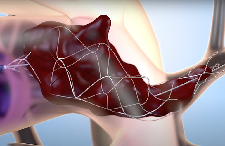 An illustration showing Flow Medical's nitinol scaffold expanding inside a clot.