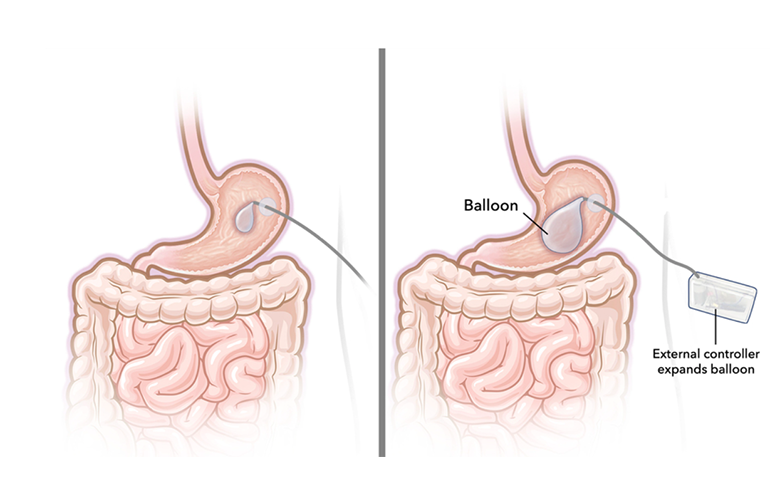 MIT engineers develop adjustable gastric balloon
