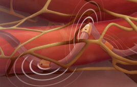 An illustration of Medtronic's Symplicity Spyral renal denervation (RDN) ablation catheter