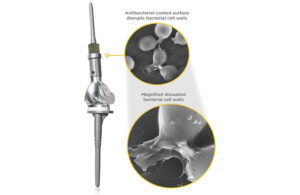 An image showing the Onkos Surgical ELEOS Limb Salvage System.