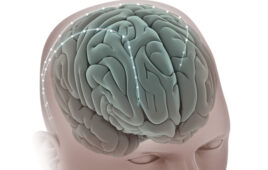 An illustration depicting Medtronic SenSight leads implanted in a patient for deep brain stimulation.