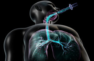 An illustration showing a nebulizer delivering an inhaled drug deep into the lungs.