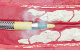 An illustration of the Shockwave Medical Javelin peripheral intravascular lithotripsy catheter breaking up calcium in blocked blood vessels.