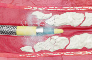An illustration of the Shockwave Medical Javelin peripheral intravascular lithotripsy catheter breaking up calcium in blocked blood vessels.