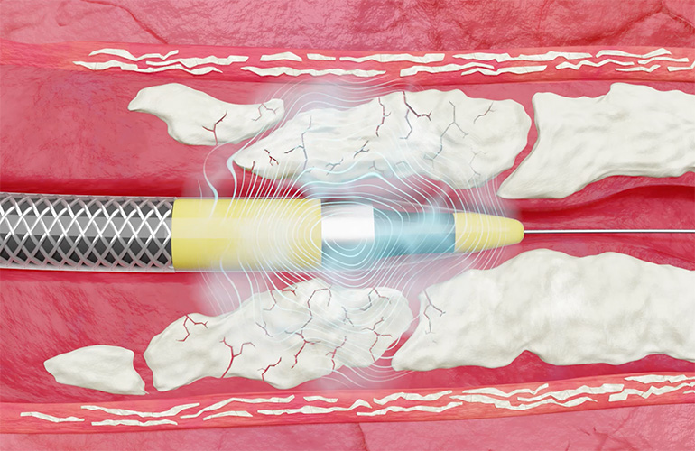 An illustration of the Shockwave Medical Javelin peripheral intravascular lithotripsy catheter breaking up calcium in blocked blood vessels.