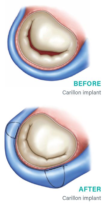A before-and-after illustration showing the Carillon Mitral Contour System implant cinching the mitral valve annulus from the coronary sinus.