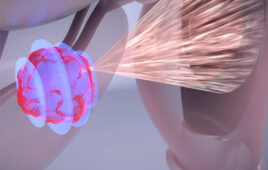 An illustration showing the The Focal One Robotic HIFU system ablating a tumor with ultrasound energy.