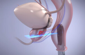 An illustration showing the Focal One Robotic HIFU system imaging a prostate tumor.