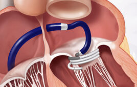 An illustration showing the Edwards Lifesciences Sapien M3 transcatheter mitral valve replacement (TMVR) system's dock being placed in the heart. [Image courtesy of Edwards Lifesciences]