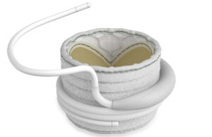 An image of the Edwards Lifesciences Sapien M3 transcatheter mitral valve replacement (TMVR) system, including the dock and valve.