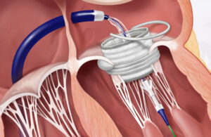 An illustration showing the Edwards Lifesciences Sapien M3 transcatheter mitral valve replacement (TMVR) system's valve being placed in the heart. [Image courtesy of Edwards Lifesciences]