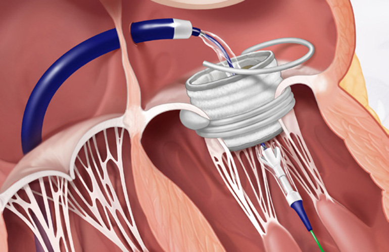 An illustration showing the Edwards Lifesciences Sapien M3 transcatheter mitral valve replacement (TMVR) system's valve being placed in the heart. [Image courtesy of Edwards Lifesciences]
