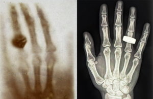 This is an image from the SpaceX Fram2 crew and Flight Surgeon Kaleigh Stabenau that shows the first medical X-ray ever taken, 130 years ago (on the left and the first X-ray image taken in space on the right. The space X-ray was part of the SpaceXray project.