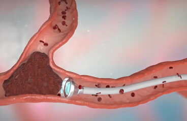An illustration showing the Artedrone Sasha thrombectomy catheter approaching a blood clot.