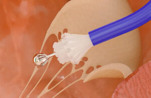 An illustration depicting Capstan Medical's transcatheter heart valve implant emerging from the delivery catheter sheath.