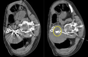 CT scans showing clear visualization of Embolization Inc. Nitinol Enhanced Device (NED) and poor visualization of traditional metal coils.