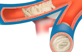 An illustration of Embolization Inc.'s Nitinol Enhanced Device (NED).