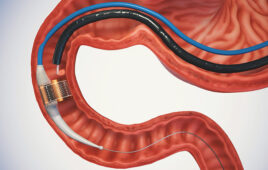 An illustration of the Endogenex ReCET system inside a patient.