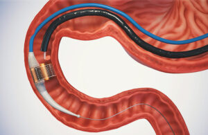 An illustration of the Endogenex ReCET system inside a patient.
