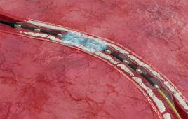 Shockwave Medical's intravascular lithotripsy catheters (like the E8 pictured here) generate sonic pressure waves to crack calcium within blood vessels without damaging the surrounding soft tissue. [Image courtesy of Johnson & Johnson MedTech]
