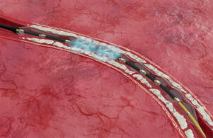An illustration showing Shockwave Medical's E8 IVL catheter generating sonic pressure waves to crack calcium within blood vessels without damaging the surrounding soft tissue.
