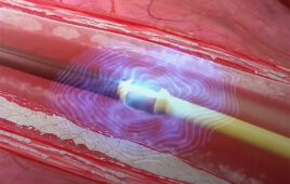 An illustration of Shockwave Medical's intravascular lithotripsy catheters generating sonic pressure waves to crack calcium within blood vessels without damaging the surrounding soft tissue.
