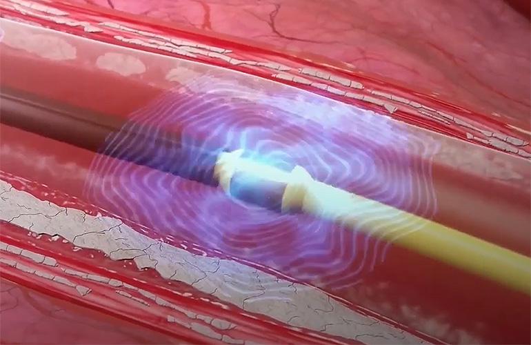 An illustration of Shockwave Medical's intravascular lithotripsy catheters generating sonic pressure waves to crack calcium within blood vessels without damaging the surrounding soft tissue.
