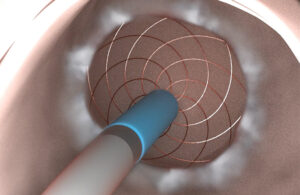 An illustration showing a view from the endoscope of the Aqua Medical radiofrequency vapor ablation catheter deploying steam inside the duodenum.