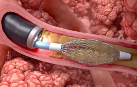 An illustration showing the Galvanize Therapeutics RheOx catheter coming out of a bronchoscope in a patient's airway.