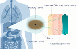 An illustration depicting Petal Surgical's acoustic liquefaction platform for incisionless surgery.