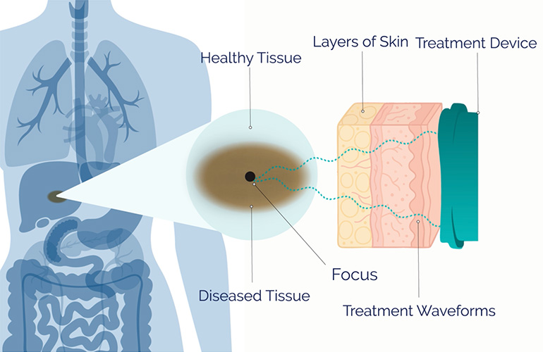 An illustration depicting Petal Surgical's acoustic liquefaction platform for incisionless surgery.