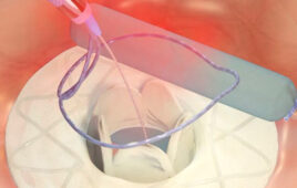 An image of Adona Medical's interatrial shunt and the induction catheter used for post-implantation adjustments.